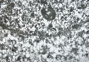 F,50y. | progressive multifocal leukoencephalopathy- viral particles in a glial cell F,50y. | progressive multifocal leukoencephalopathy- viral particles in a glial cell